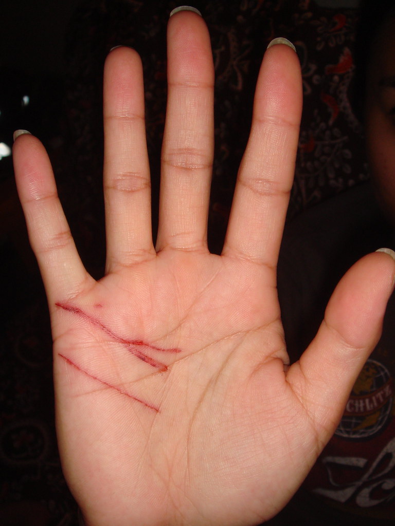 Scratches caused by playing with cat without cutting her nails.